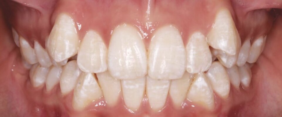 Antes — ortodoncia con brackets