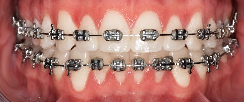 Después — ortodoncia con brackets