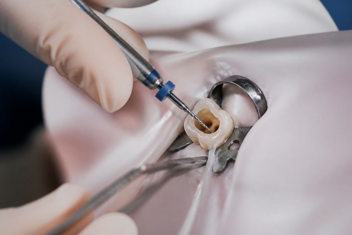 Tratamiento de endodoncia y conductos