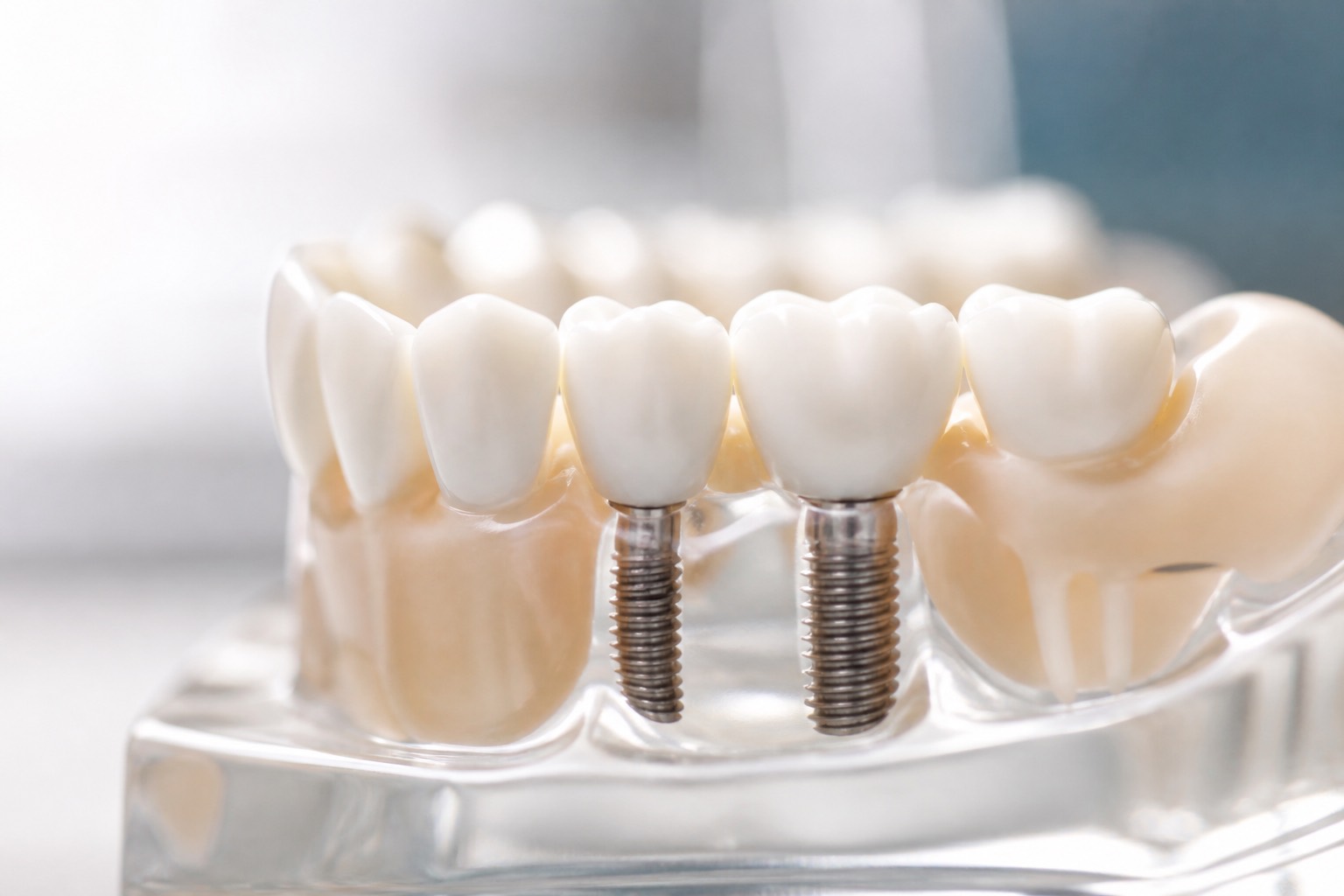 Rehabilitación oral e implantología dental
